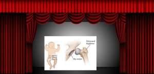 Hip Dysplasia Car Seat Hire